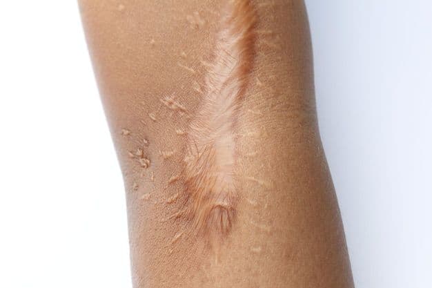 Close-up of a raised scar on brown skin.